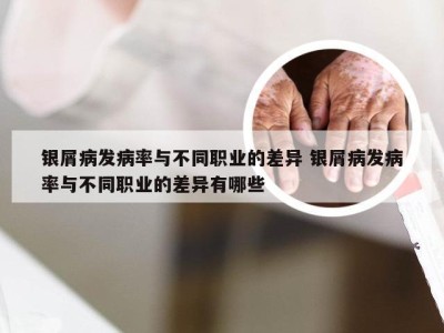 银屑病发病率与不同职业的差异 银屑病发病率与不同职业的差异有哪些