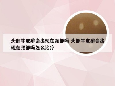 头部牛皮癣会出现在颈部吗 头部牛皮癣会出现在颈部吗怎么治疗