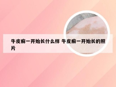 牛皮癣一开始长什么样 牛皮癣一开始长的照片