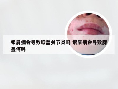 银屑病会导致膝盖关节炎吗 银屑病会导致膝盖疼吗