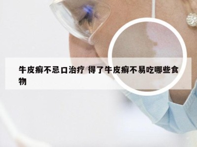 牛皮癣不忌口治疗 得了牛皮癣不易吃哪些食物