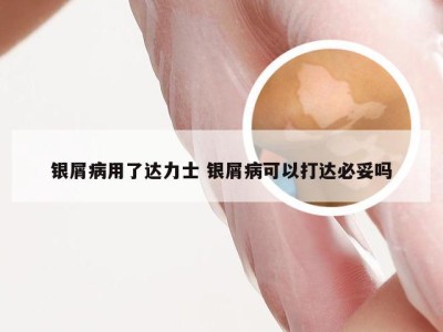银屑病用了达力士 银屑病可以打达必妥吗