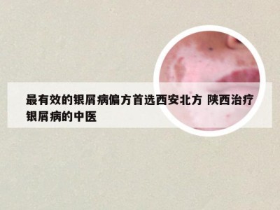最有效的银屑病偏方首选西安北方 陕西治疗银屑病的中医