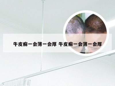 牛皮癣一会薄一会厚 牛皮癣一会薄一会厚