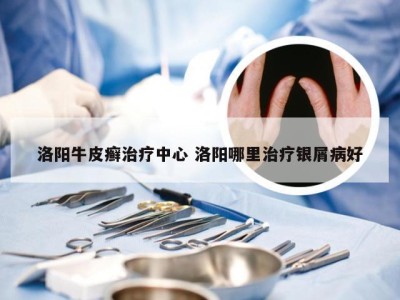洛阳牛皮癣治疗中心 洛阳哪里治疗银屑病好