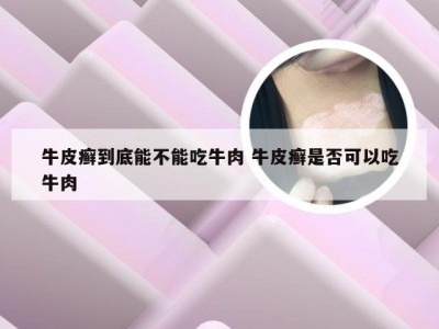 牛皮癣到底能不能吃牛肉 牛皮癣是否可以吃牛肉