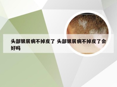 头部银屑病不掉皮了 头部银屑病不掉皮了会好吗