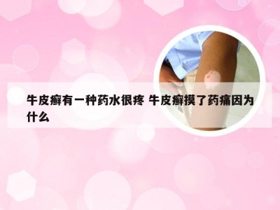 牛皮癣有一种药水很疼 牛皮癣摸了药痛因为什么