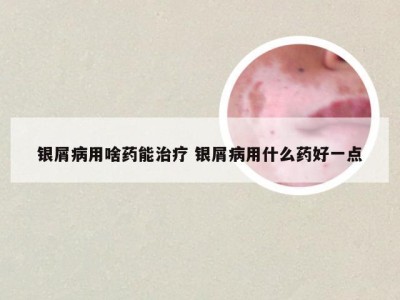 银屑病用啥药能治疗 银屑病用什么药好一点
