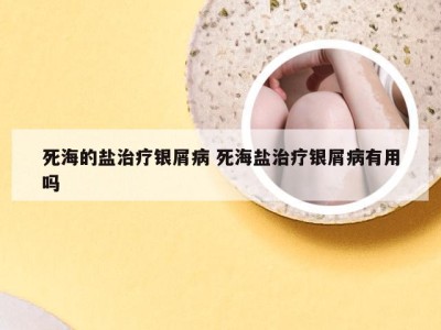 死海的盐治疗银屑病 死海盐治疗银屑病有用吗