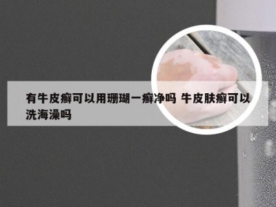 有牛皮癣可以用珊瑚一癣净吗 牛皮肤癣可以洗海澡吗