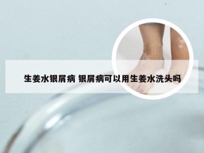 生姜水银屑病 银屑病可以用生姜水洗头吗