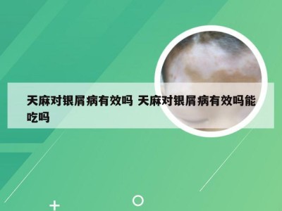 天麻对银屑病有效吗 天麻对银屑病有效吗能吃吗