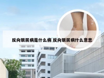 反向银屑病是什么病 反向银屑病什么意思