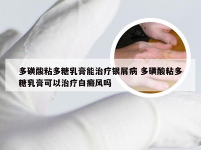 多磺酸粘多糖乳膏能治疗银屑病 多磺酸粘多糖乳膏可以治疗白癜风吗