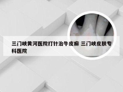 三门峡黄河医院打针治牛皮癣 三门峡皮肤专科医院