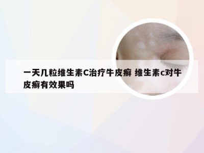 一天几粒维生素C治疗牛皮癣 维生素c对牛皮癣有效果吗