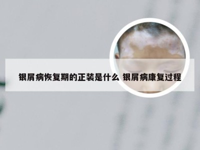银屑病恢复期的正装是什么 银屑病康复过程