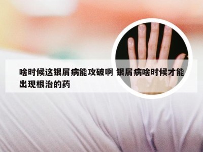 啥时候这银屑病能攻破啊 银屑病啥时候才能出现根治的药
