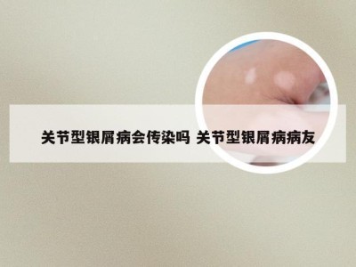 关节型银屑病会传染吗 关节型银屑病病友