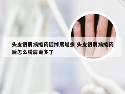头皮银屑病擦药后掉屑增多 头皮银屑病擦药后怎么脱屑更多了