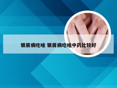 银屑病吃啥 银屑病吃啥中药比较好