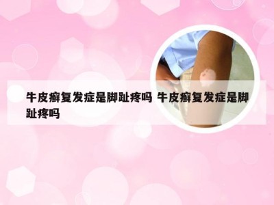 牛皮癣复发症是脚趾疼吗 牛皮癣复发症是脚趾疼吗