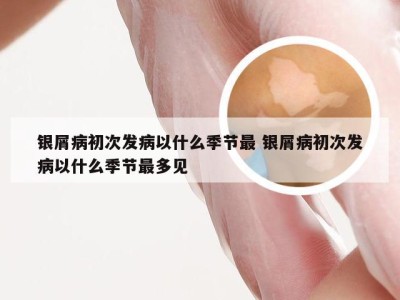 银屑病初次发病以什么季节最 银屑病初次发病以什么季节最多见