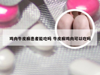 鸡肉牛皮癣患者能吃吗 牛皮癣鸡肉可以吃吗