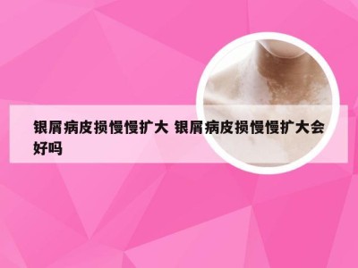 银屑病皮损慢慢扩大 银屑病皮损慢慢扩大会好吗