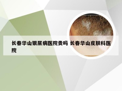 长春华山银屑病医院贵吗 长春华山皮肤科医院