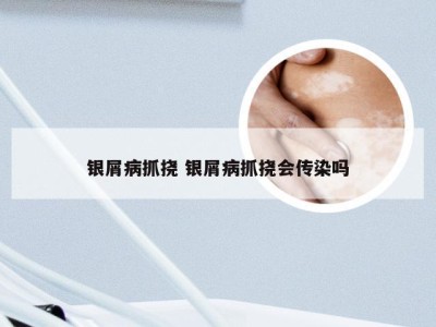 银屑病抓挠 银屑病抓挠会传染吗