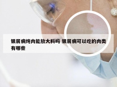 银屑病炖肉能放大料吗 银屑病可以吃的肉类有哪些