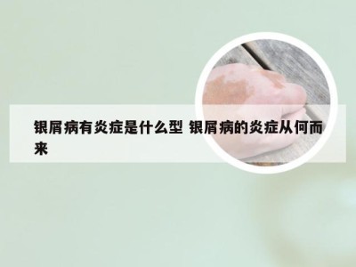 银屑病有炎症是什么型 银屑病的炎症从何而来