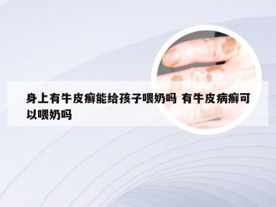 身上有牛皮癣能给孩子喂奶吗 有牛皮病癣可以喂奶吗