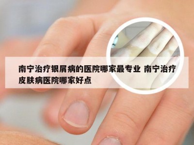 南宁治疗银屑病的医院哪家最专业 南宁治疗皮肤病医院哪家好点
