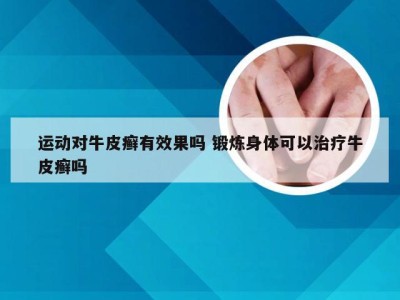 运动对牛皮癣有效果吗 锻炼身体可以治疗牛皮癣吗