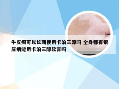 牛皮癣可以长期使用卡泊三淳吗 全身都有银屑病能用卡泊三醇软膏吗