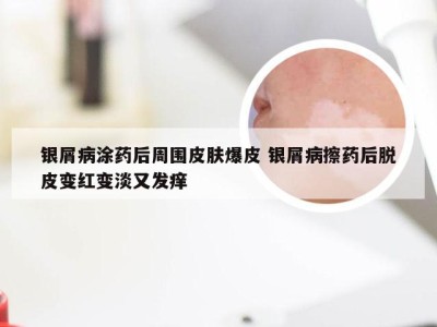 银屑病涂药后周围皮肤爆皮 银屑病擦药后脱皮变红变淡又发痒