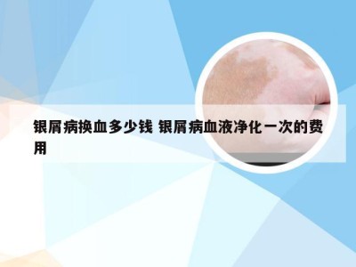 银屑病换血多少钱 银屑病血液净化一次的费用