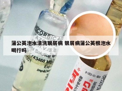 蒲公英泡水清洗银屑病 银屑病蒲公英根泡水喝行吗