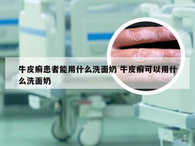 牛皮癣患者能用什么洗面奶 牛皮癣可以用什么洗面奶