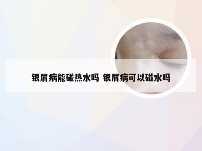 银屑病能碰热水吗 银屑病可以碰水吗
