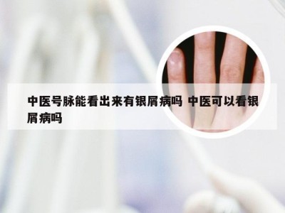 中医号脉能看出来有银屑病吗 中医可以看银屑病吗
