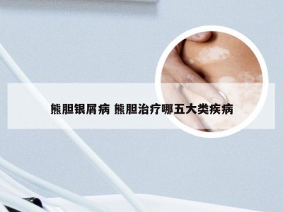 熊胆银屑病 熊胆治疗哪五大类疾病