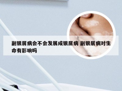 副银屑病会不会发展成银屑病 副银屑病对生命有影响吗