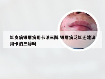 红皮病银屑病用卡泊三醇 银屑病泛红还建议用卡泊三醇吗