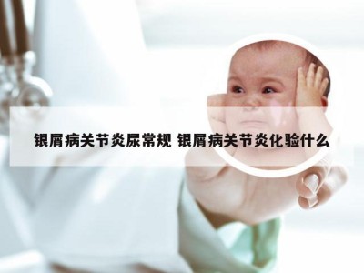 银屑病关节炎尿常规 银屑病关节炎化验什么
