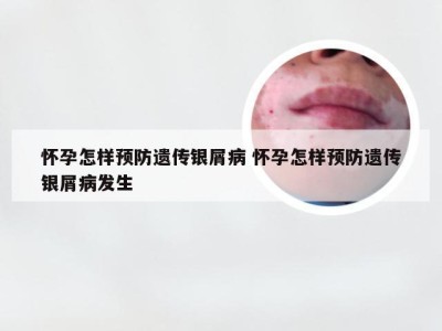 怀孕怎样预防遗传银屑病 怀孕怎样预防遗传银屑病发生
