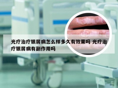 光疗治疗银屑病怎么样多久有效果吗 光疗治疗银屑病有副作用吗